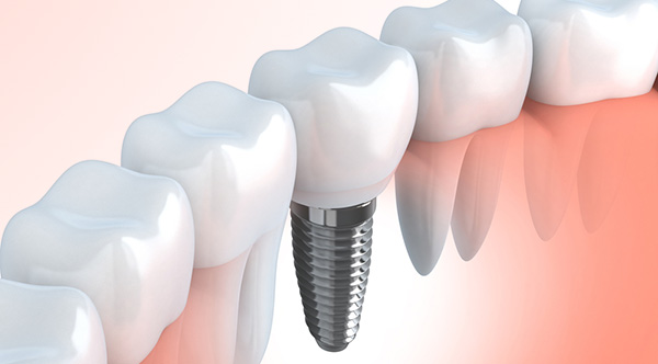 インプラント治療